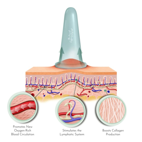 Add on: Cupping 10min